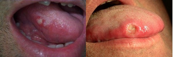 Чому збоку болить мова