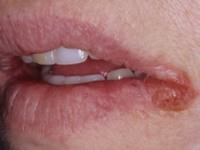 Запах з рота: причини і лікування