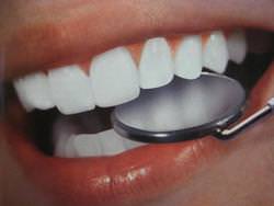 Як відбілити зуби в домашніх умовах?