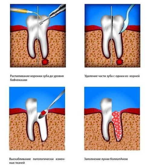 Причини і лікування гранульоми на корені зуба