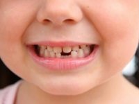Які зубні протези краще поставити