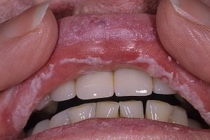 Лікування стоматиту на губі