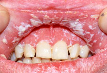 Лікування кандидозу порожнини рота у дорослих і дітей