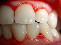Які бувають зубні протези