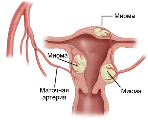 Міома матки як лікувати? Симптоми, причини та фото