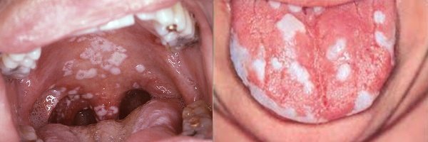 Лікування кандидозу порожнини рота у дорослих і дітей