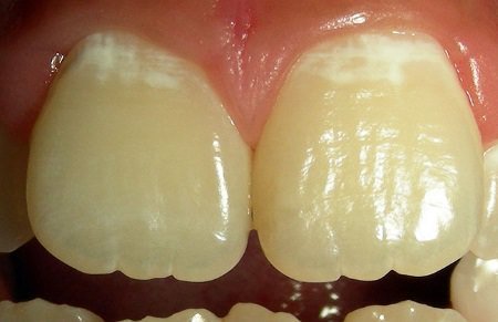 Як лікувати карес на зубах в домашніх умовах