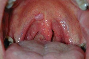 Причини і лікування папіломи в горлі