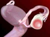 Параовариальная кіста яєчника і вагітність, ліва, права.