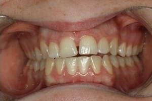 Відгуки на відбілювання зубів лазером
