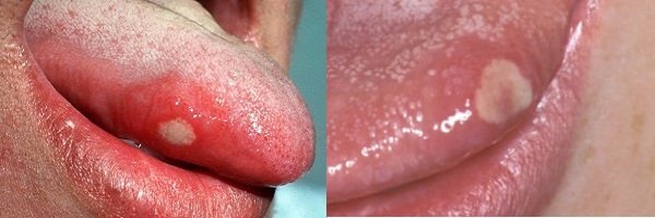 Чому збоку болить мова