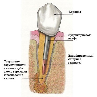 Причини і лікування кісти на корені зуба