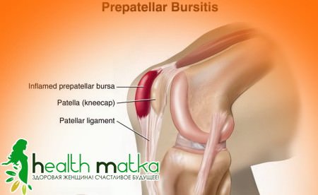 Методи лікування бурситу колінного суглоба
