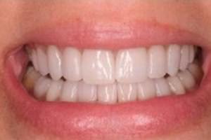 Відгуки на відбілювання зубів лазером