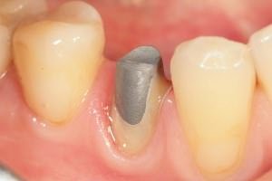 Застосування штифтів в стоматології