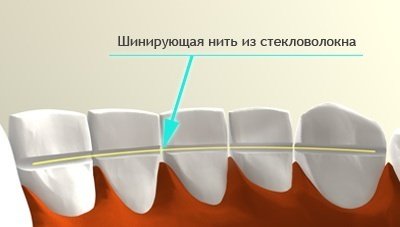 Шинування рухомих зубів при захворюваннях пародонту