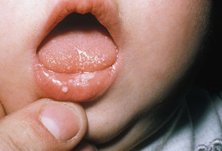 Лікування герпетичного стоматиту у дітей