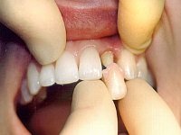 Як виростити нові зуби?