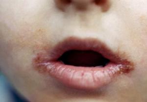 Чим можна і потрібно лікувати заїди в куточках губ