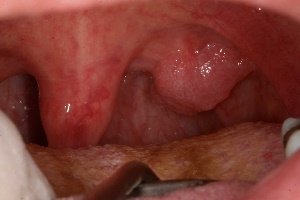 Причини і лікування папіломи в горлі