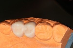Установка коронок на зуби