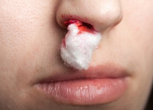 Як зупинити кров з носа під час вагітності