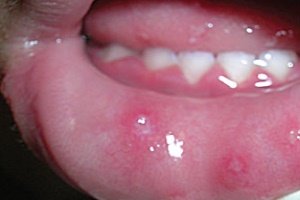 Причини і лікування болячок у роті