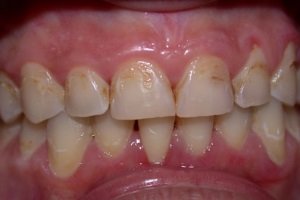 Відгуки пацієнтів і стоматологів на люмініри