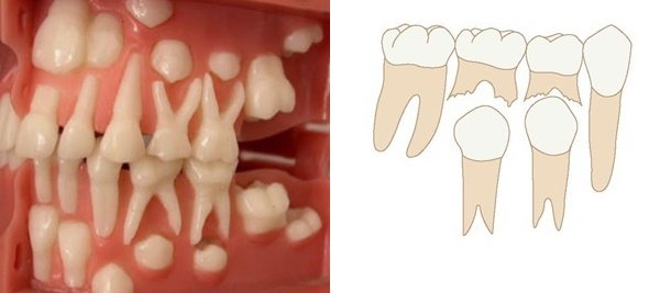 Молочні зуби у дітей: скільки їх і коли випадають?