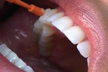 Фторування зубів для профілактики карієсу