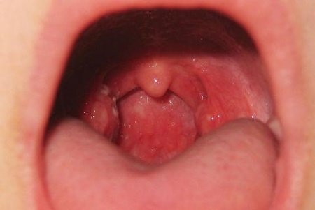 Причини і лікування болю в горлі при ковтанні