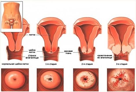 Основні стадії раку шийки матки: діагностика та способи лікування