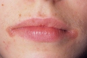 Як вилікувати болячки на губі