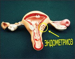 Як лікувати энометриоз матки? Симптоми, наслідки, фото