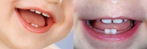 Як ріжуться перші зубки у дитини