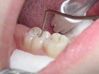 Ремінералізація емалі зубів