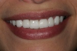 Відгуки пацієнтів і стоматологів на люмініри