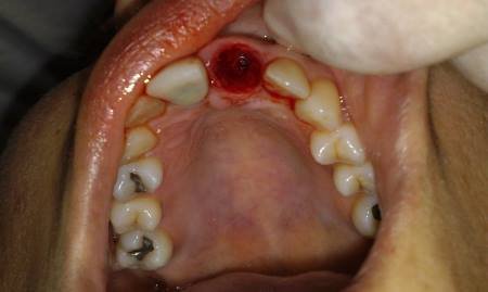 Кровотеча після видалення зуба