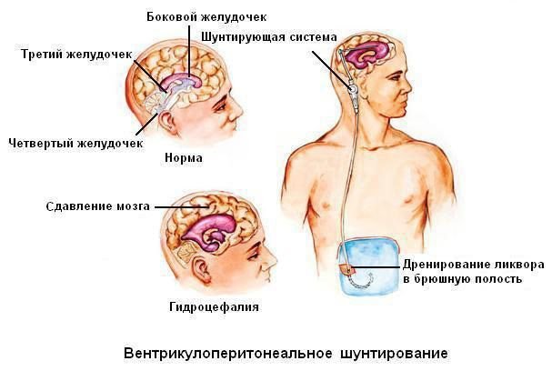 Гідроцефалія головного мозку: причини захворювання і методи лікування