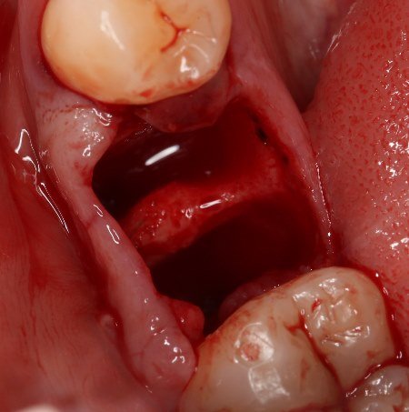 Альвеоліт лунки після видалення зуба