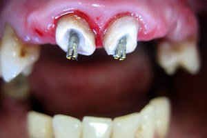 Застосування штифтів в стоматології