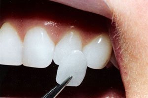 Які бувають зубні протези