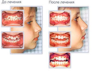 Що таке трейнер для зубів?