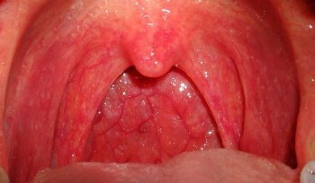Запах з рота: причини і лікування