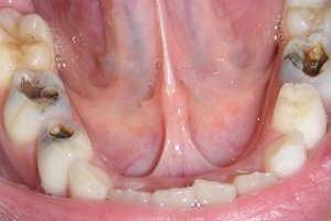 Причини виникнення карієсу зубів