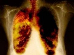 Як очистити легені після куріння?