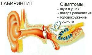 Лабіринтит або запалення внутрішнього вуха, як і чим лікувати