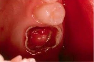 Причини і лікування пульпіту молочних зубів у дітей