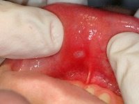 Ціна на лікування пульпіту зуба