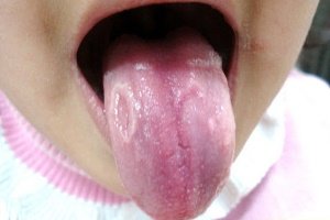 Причини плям мовою у дитини